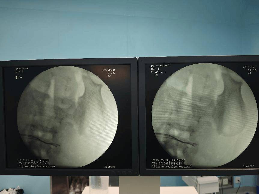 整整37颗!云南4岁孩子身体里取出……医生紧急提醒!