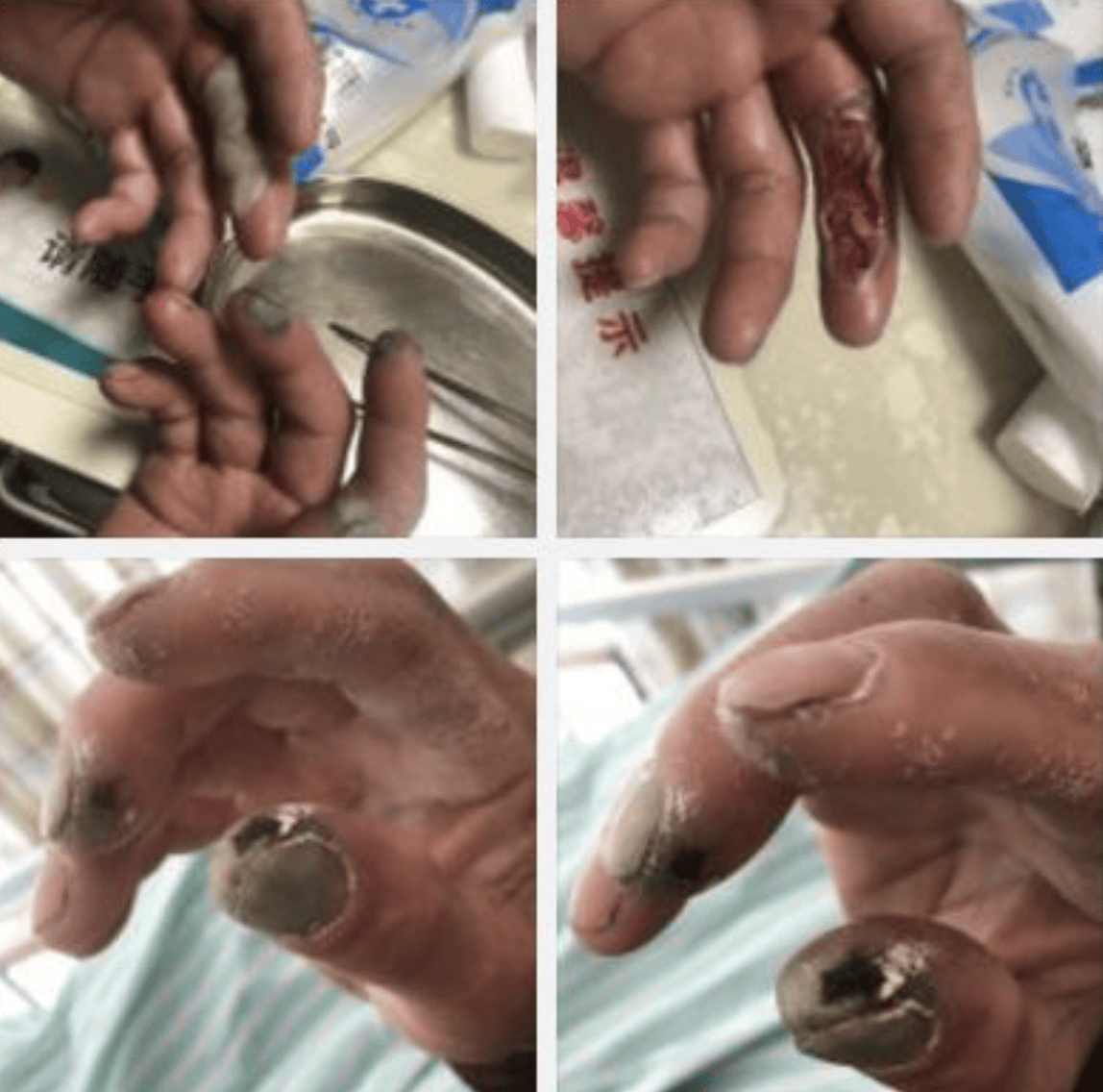 杭州女子接触氢氟酸中毒身亡,警方介入!曾有环卫工手遭腐蚀